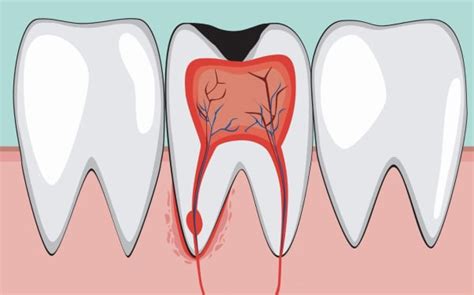 Everything You Need to Know About Wisdom Tooth Removal: Procedure, Recovery, and Tips for Managing Pain and Complications