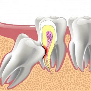 Everything You Need to Know About Wisdom Tooth Removal: Procedure, Recovery, and Tips for Managing Pain and Complications