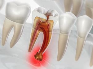 Everything You Need to Know About Wisdom Tooth Removal: Procedure, Recovery, and Tips for Managing Pain and Complications