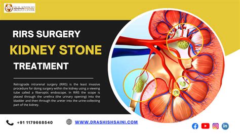 Comprehensive Guide to Organ Transplantation: Life-Saving Treatments, Recovery Processes, and Key Considerations for Successful Transplants